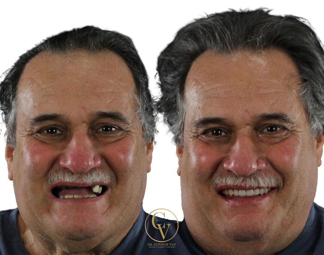 DeLand Dental Implant Before and After 1