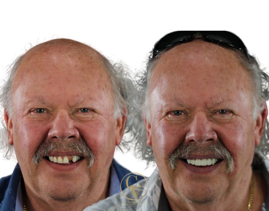 DeLand Dental Implant Before and After 5